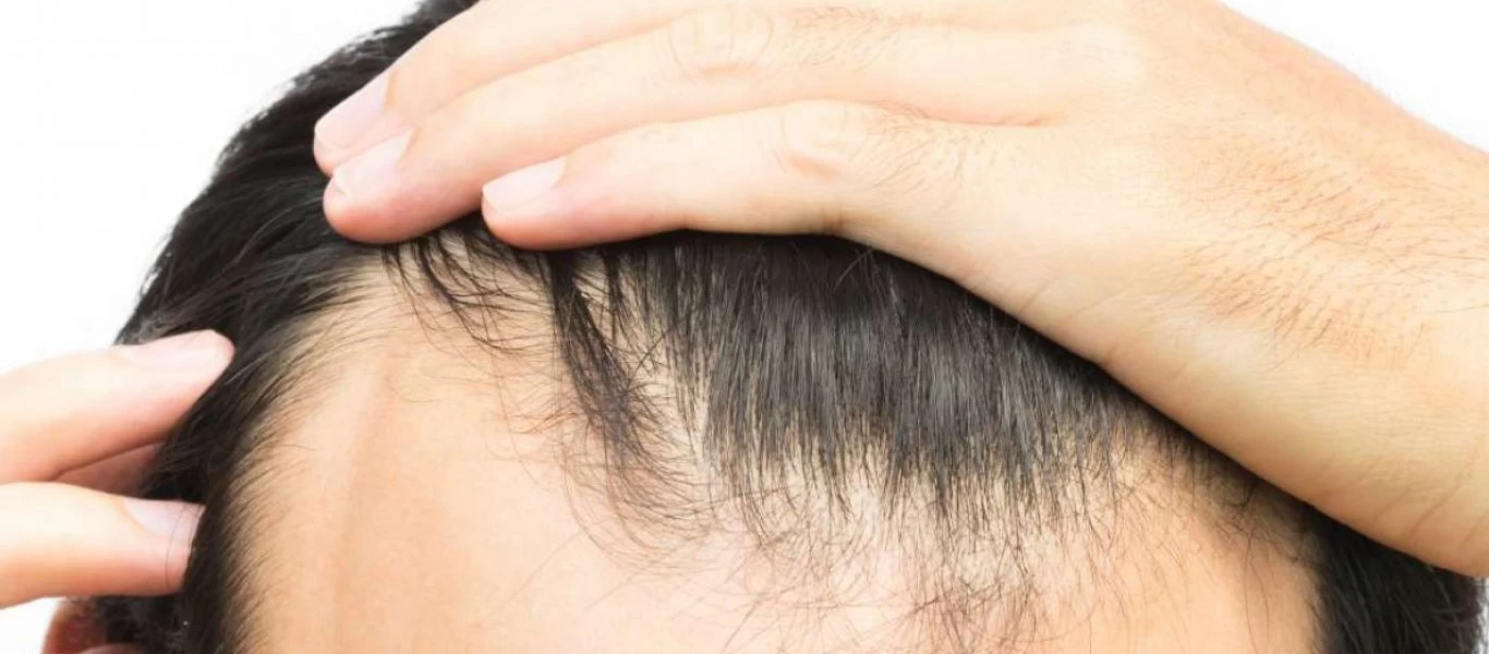 Αραίωση στα μαλλιά: Πότε είναι σημάδι για κάτι σοβαρό